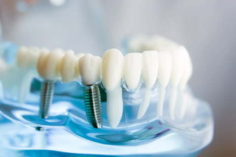 Model mit Implantaten