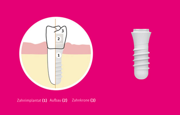 ZERAMEX Keramikimplantate